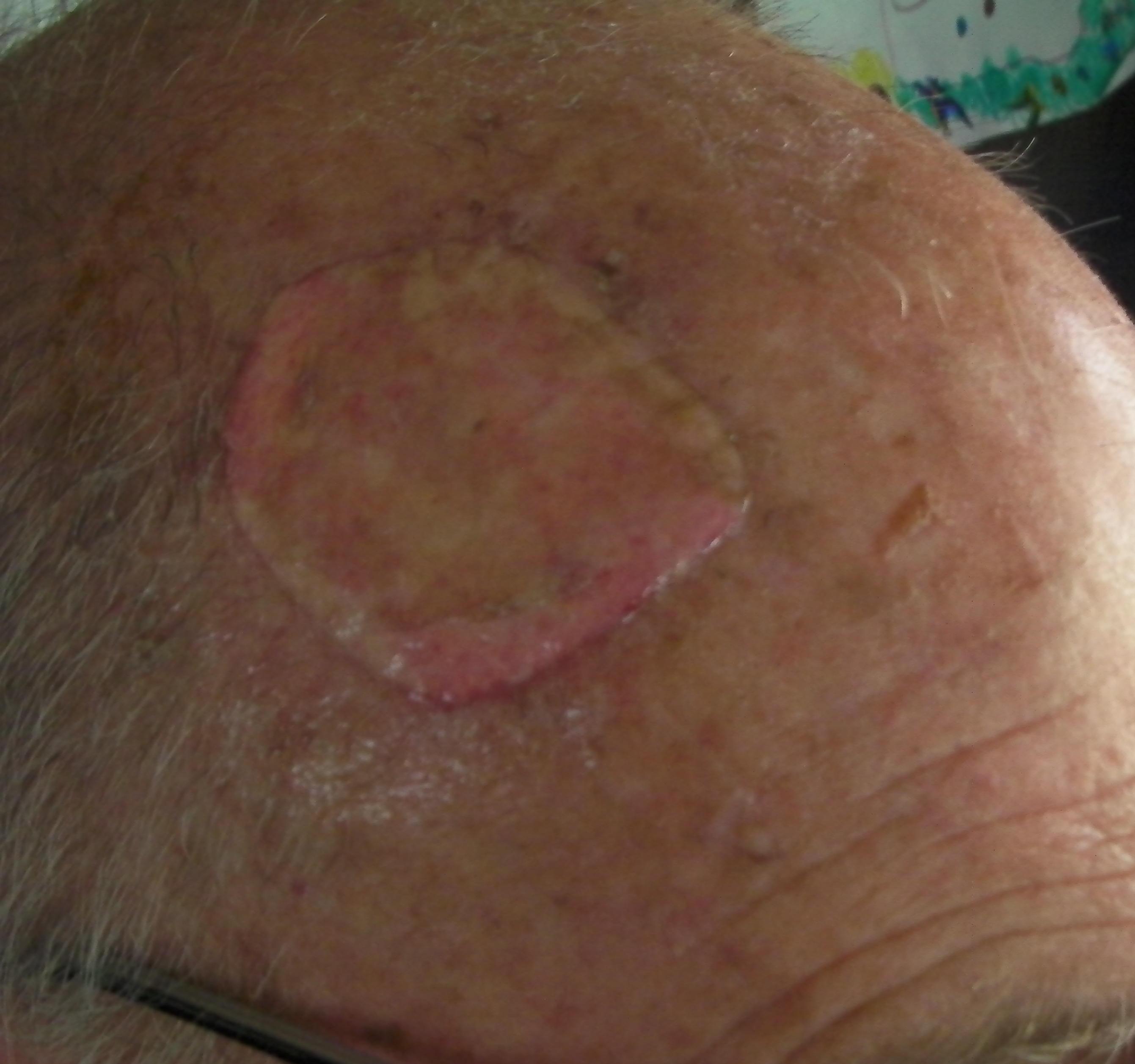 Operatieverslag: Thierschplastiek - split skin graft